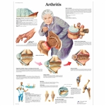 3B Scientific Arthritis Chart
