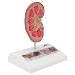3B Scientific Kidney Stone Model Smart Anatomy